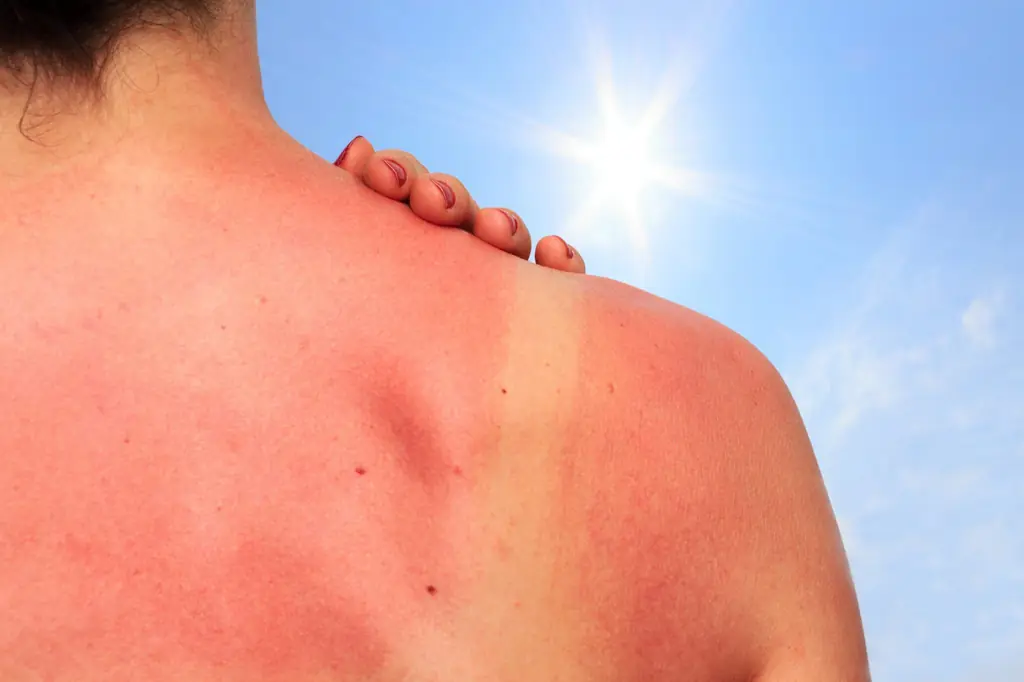 Tratamente naturiste pentru arsurile solare